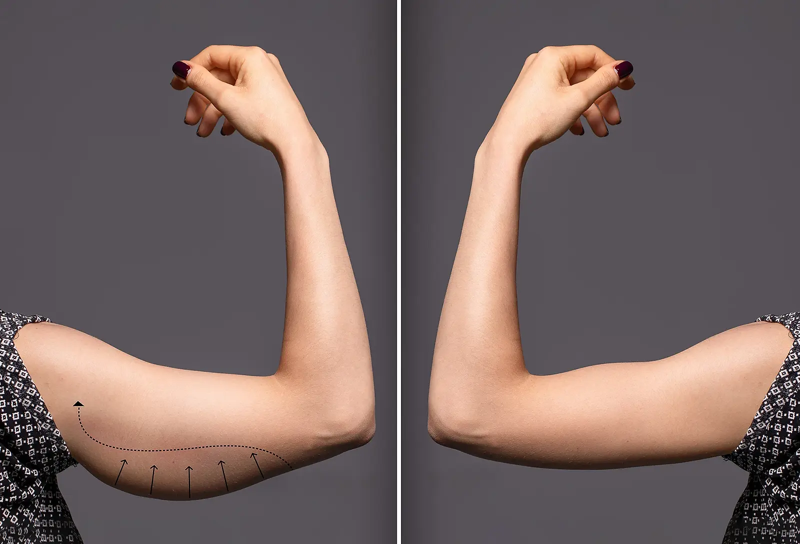 woman arms with bat wings comparison between before and after brachioplasty surgery